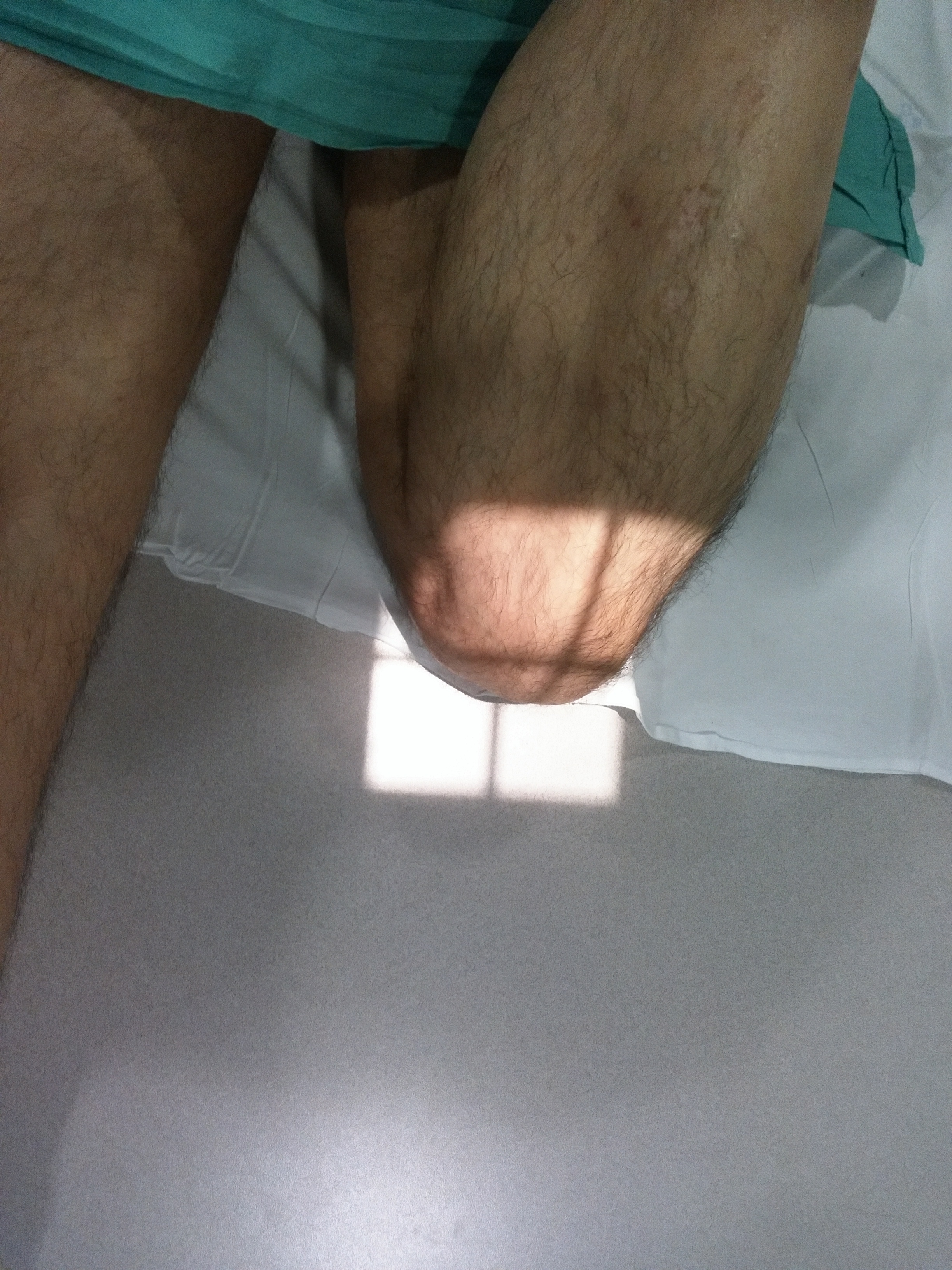 Tangential Patella Projection
